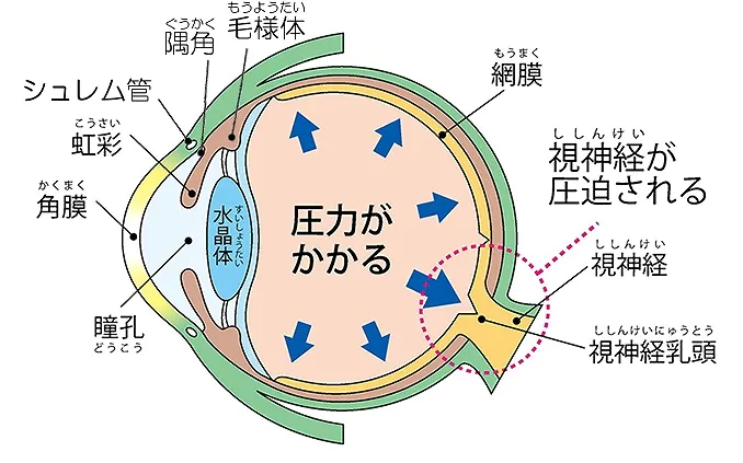 緑内障とは