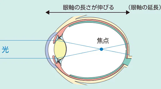 近視進行防止