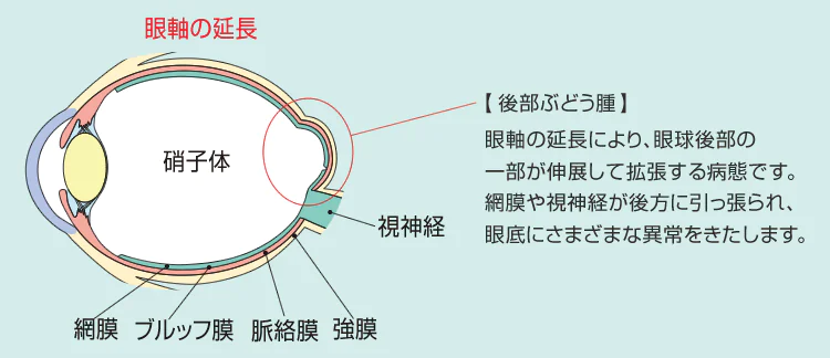 近視進行防止