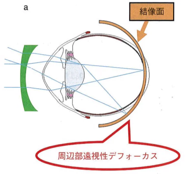 眼鏡による矯正