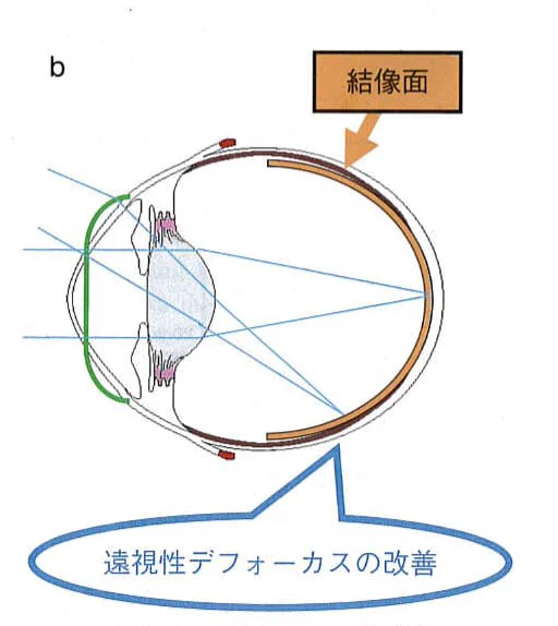 眼鏡による矯正