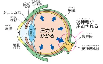 緑内障とは