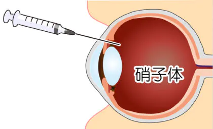 抗VEGF硝子体注射