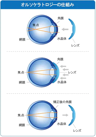 オルソケラトロジー治療